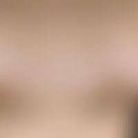 Usual melanocytic nevus. Chronic stationary, 0.2-2.0 cm in size, sharply defined, soft, light to ...