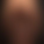 Naevus melanozytärer.&nbsp;Typ: Kongenitaler Riesennaevus vom Badehosentyp.
