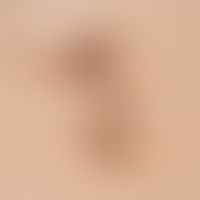 Nevus, melanocytic. Congenital melanocytic nevus of the spilus nevus type
