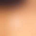 Gewöhnlicher&nbsp;melanozytärer Naevus. Typ: Halo-Naevus, nahezu vollstädnige Rückbildung der mel...