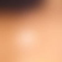 Common melanocytic nevus. type: Halo-nevus, almost complete regression of the melanocytic nevi, w...