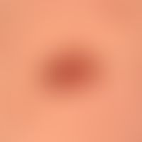 Nevus, melanocytic type: Dysplastic melanoytic nevus, growth in the last 6 months, asymmetry of t...