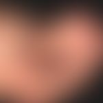 Naevus, melanozytärer. Typ: Akraler, erworbener&nbsp;melanozytärer Naevus.
