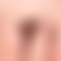 Nevus, melanocytic. Type: Congential melanocytic nevus.
