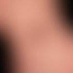 Naevus, melanozytärer. Typ: Kongentialer&nbsp;melanozytärer Naevus.
