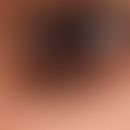 Naevus, melanozytärer. Typ: Kongentialer&nbsp;melanozytärer Naevus.
