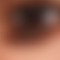 Naevus, melanozytärer. Typ: Kongentialer&nbsp;melanozytärer Naevus.
