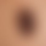 Naevus, melanozytärer, dysplastischer. Unregelmäßig begrenzter und pigmentierter melanozytärer Na...