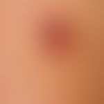 Naevus, melanozytärer, dysplastischer. 1,5 x 0,8 cm großer, unterschiedlich strukturierter, mehrf...