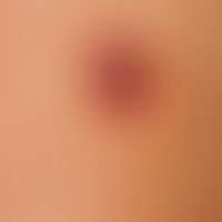 Nevus, melanocytic, dysplastic. 1.5 x 0.8 cm in size, differently structured, multicoloured melan...