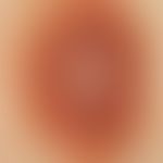 Naevus, melanozytärer, dysplastischer. Auflichtmikroskopie: Zentrale Regressionszone mit fokalem ...