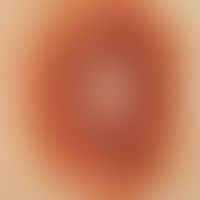 Nevus, melanocytic, dysplastic. reflected light microscopy: Central regression zone with focal pi...