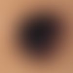 Naevus, melanozytärer, dysplastischer. Dysplastischer Naevus vom Junktionstyp mit "radial streami...