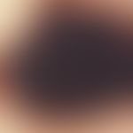 Naevus, melanozytärer, dysplastischer. Dysplastischer Naevus vom Compoundtyp: Brown/black dots vo...