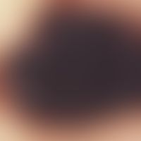 Nevus, melanocytic, dysplastic. dysplastic nevus of the compound type: brown/black dots against a...