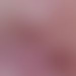 Naevus, melanozytärer, dysplastischer. Dysplastischer Naevus vom Compoundtyp (Ausschnitt). Areal ...