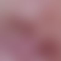 Nevus, melanocytic, dysplastic. compound type dysplastic nevus (section). area with evenly distri...