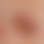 Naevus, melanozytärer, dysplastischer. 2,0 x 1,5 cm messende, unscharf begrenzte, sehr unterschie...