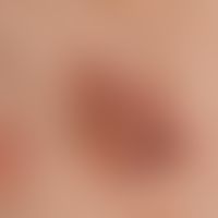 Naevus, melanozytärer, dysplastischer. 2,0 x 1,5 cm messende, unscharf begrenzte, sehr unterschie...