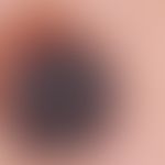 Naevus, melanozytärer, dysplastischer. Flach erhabener, unterschiedlich gefärbter, "unruhiger" me...