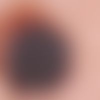 nevus, melanocytic, dysplastic. flat raised, differently colored, "restless" melanocytic nevus (h...