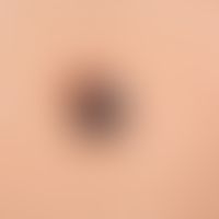 Nevus, melanocytic, dysplastic, raised, approx. 5 x 7 mm, asymmetrical, darkly pigmented papule, ...