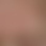 Dermal melanocytic nevus: for 12 years persistent, 0.9 x 0.9 cm in diameter, soft, sharply define...