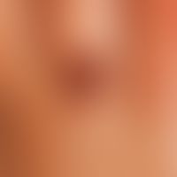 Nevus, melanocytic, congenital. congenital, initially flat, later clearly raised, sharply defined...