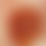 Naevus, melanozytärer, kongenitaler. Auflichtmikroskopie, homogenes Pigmentnetz.