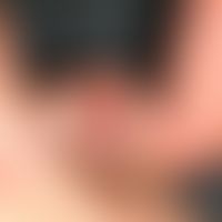 Nevus, melanocytic, congenital. 6 x 4 mm large, brownish pigmented nevus in the area of the left ...