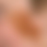 Nevus, melanocytic, congenital. since birth existing, well defined, bizarrely configured, sharply...