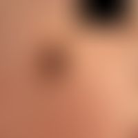 Nevus, melanocytic, congenital. solitary, chronically inpatient, approx. 2.0 x 1.5 cm in size, lo...