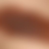 Nevus, melanocytic, congenital, chronically active, localized on the right upper arm, existing si...