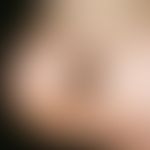 Naevus, melanozytärer, kongenitaler. Angeborene, schmerzlose, nicht aktiv wachsende, leicht erhab...