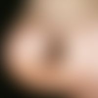Naevus, melanocytic, congenital. congenital, painless, not actively growing, slightly raised, mod...