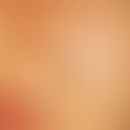 Naevus, melanozytärer, papillomatöser. Großer, deutlich über das Hautniveau erhabener Naevus im G...
