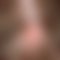 Nevus, melanocytic, papillomatous. Completely discolored, papillomatous nevus on the capillitium,...