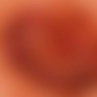nevus, melanocytic, papillomatous. reflected light microscopy: nevus in the breast area in a 27-y...