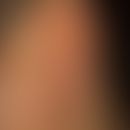 Naevussyndrom, nicht-hereditäres, dysplastisches. Multiple, erworbene, sehr dunkel pigmentierte, ...