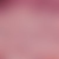 Narbe, atrophische. Vermehrt zur Oberfläche parallel verlaufende Kollagenbündel.