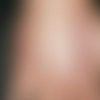 Narbe, hypertrophische:&nbsp;chronische, lineare, scharf begrenzte, mäßig indurierte, rote, glatt...
