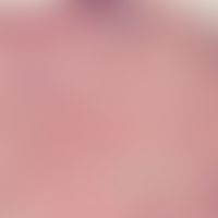 Nasenpapel, fibröse. Homogenisiertes, perifollikulär verdichtetes Bindegewebe. Schüttere Zellinfi...