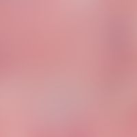 Nasenpapel, fibröse. Detailvergrößerung: Perifollikulär verdichtete Kollagenbündel.