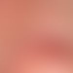 Nasal papule, fibrous n odule, about 3 years ago, about 4 mm in diameter, with a smooth surface a...