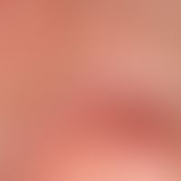 Nasenpapel, fibröse:&nbsp;vor etwa 3 Jahren entstandenes, ca. 4 mm durchmessendes Knötchen mit gl...