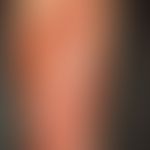Necrobiosis lipoidica: Waxy, reddish-brown, smooth, shiny infiltrate plates with several punched-...