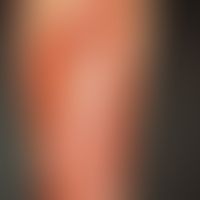 Necrobiosis lipoidica: Waxy, reddish-brown, smooth, shiny infiltrate plates with several punched-...
