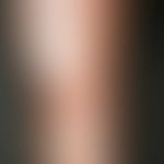 Necrobiosis lipoidica: irregularly configured, sharply defined, plate-like, atrophic, "scleroderm...