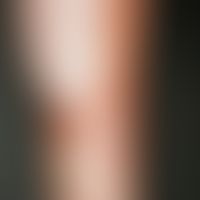Necrobiosis lipoidica: irregularly configured, sharply defined, plate-like, atrophic, "scleroderm...