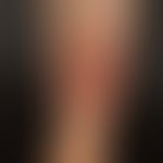 Necrobiosis lipoidica: Sharply defined, confluent marginal, reddish-brownish, centrally faded, at...